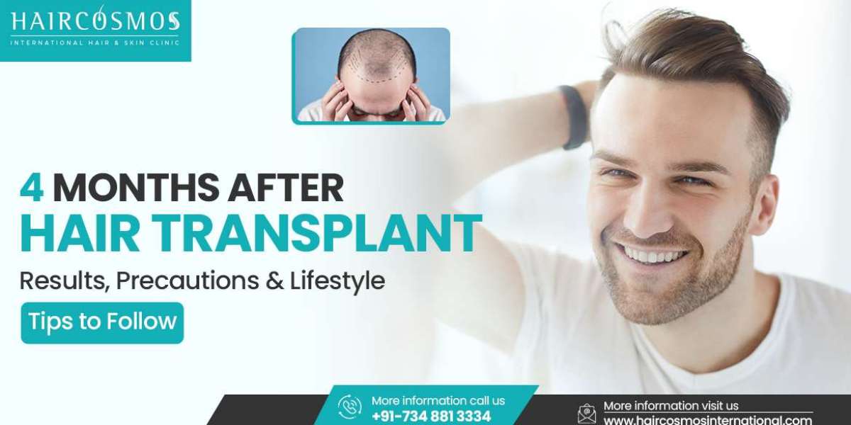 4 months after hair transplant - Facial hair transplant in bangalore