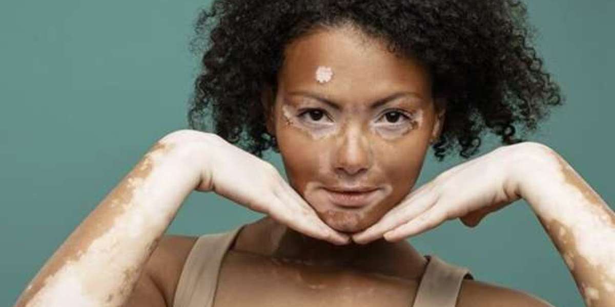 Homeopathic Treatment Therapies vs Traditional Therapies in Vitiligo: Advantages, Disadvantages & Results