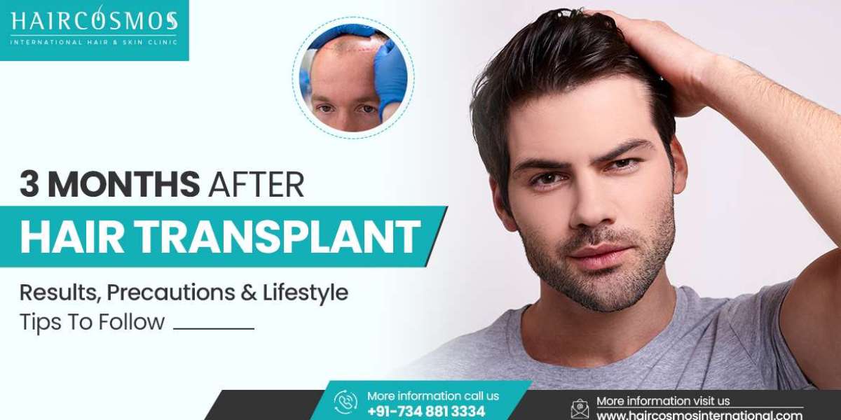 3 months after hair transplant - FUT Hair transplant in Bangalore